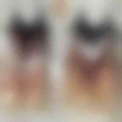 Varrás nélküli melltartó készlet | BRAPACK